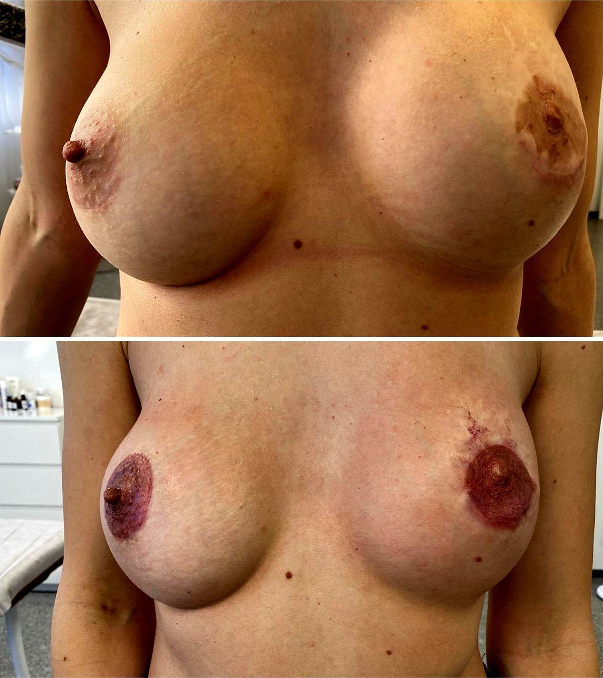 Areola restoration before and after, after breast reconstruction
