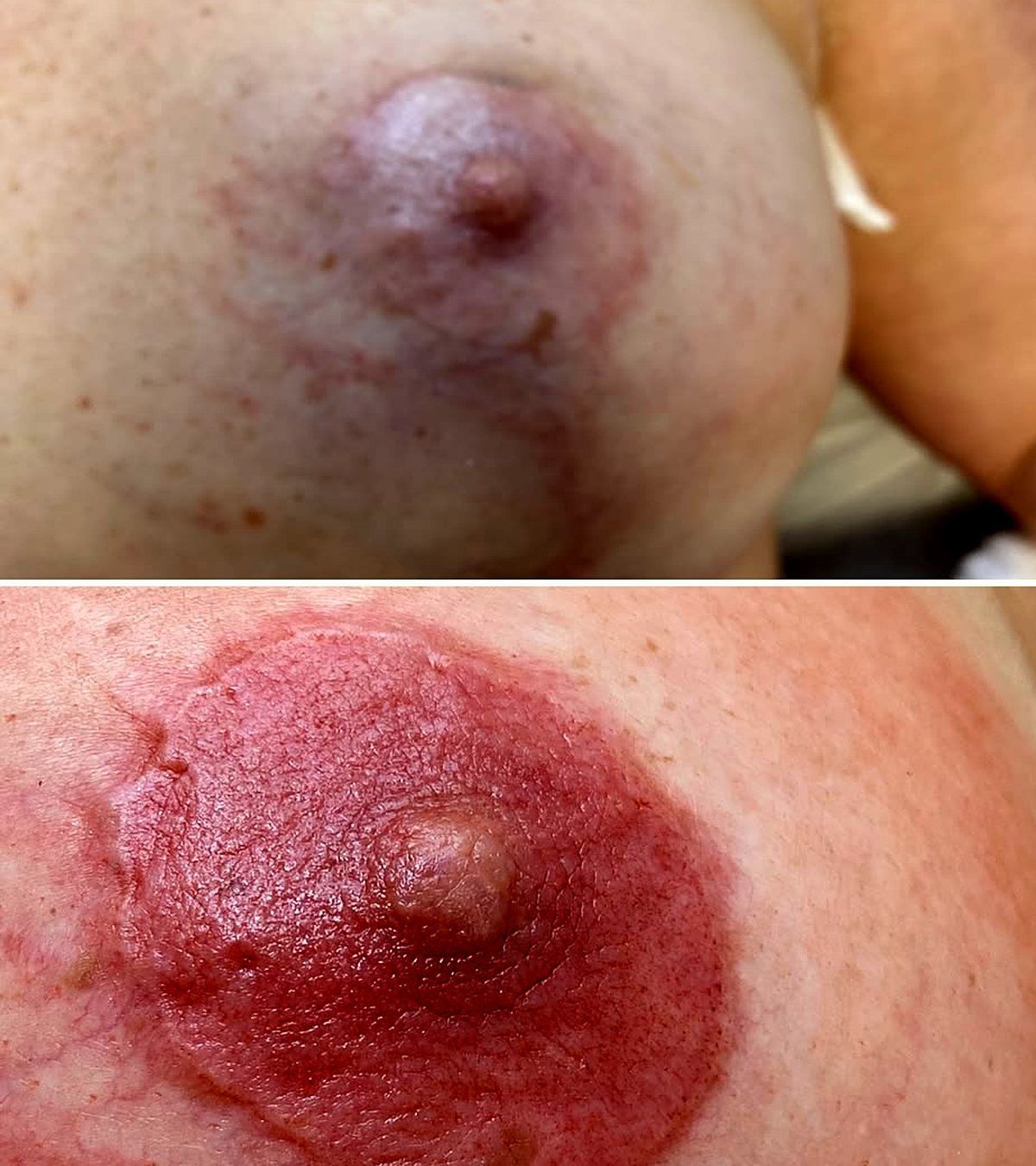 Areola restoration before and after