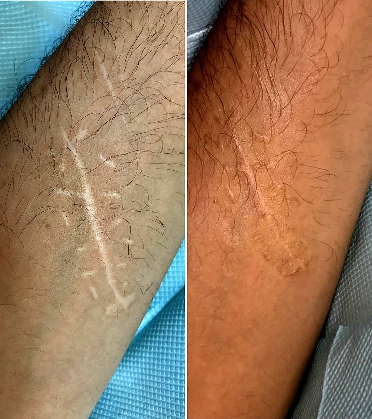Forearm scar before and after camouflage