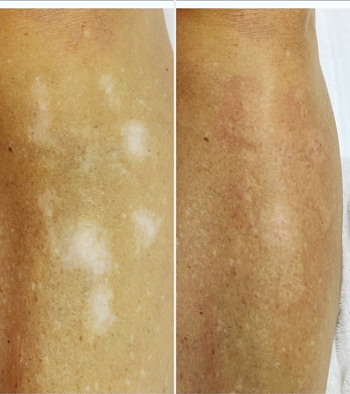 Vitiligo on the leg before and after dermopigmentation