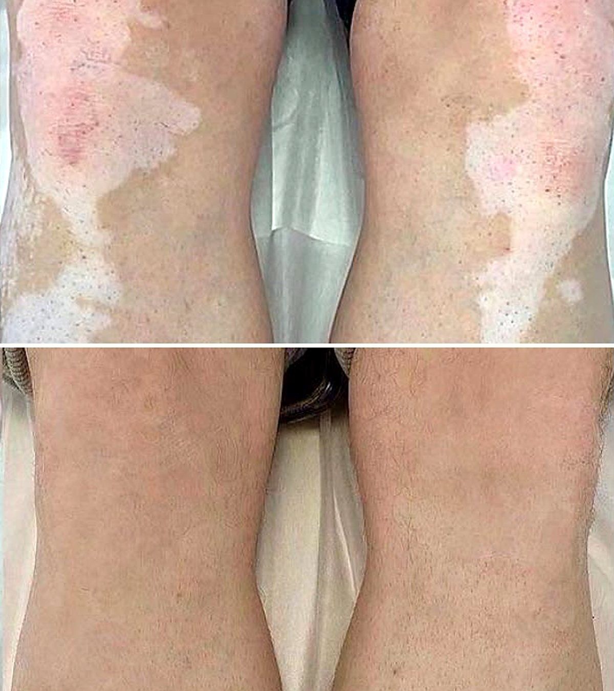 Vitiligo on the knees before and after dermopigmentation